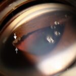 Clinical eye photograph illustrating Cataract Surgery in Uveitis