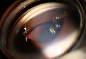 Clinical eye photograph illustrating Cataract Surgery in Uveitis