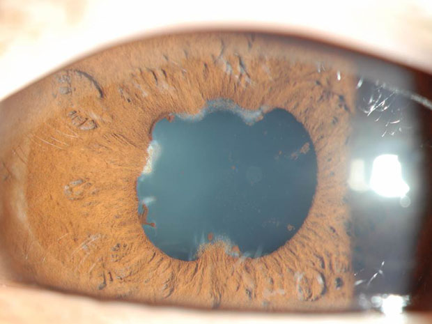 Clinical eye photograph illustrating Cataract Surgery in Uveitis