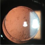 Clinical image illustrating Cataract Surgery Recovery