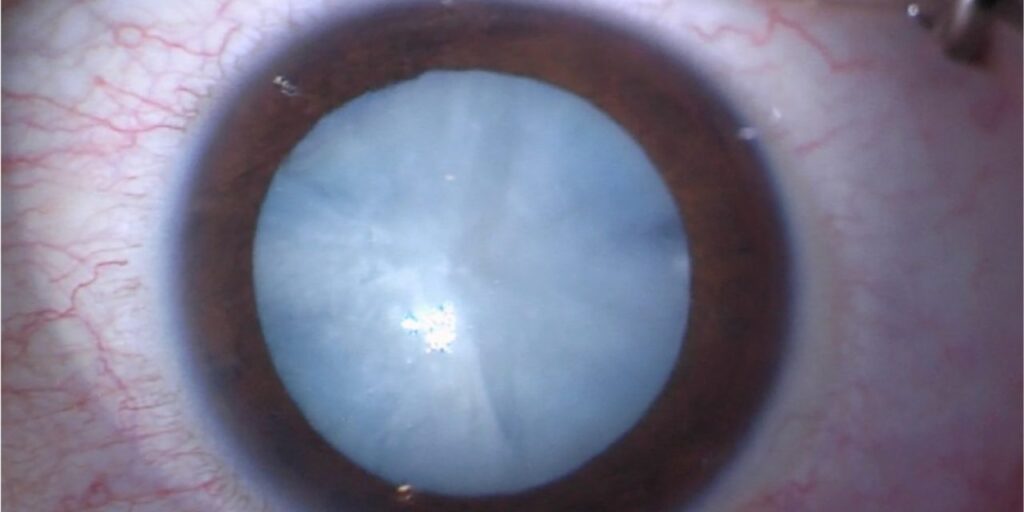 Clinical image illustrating Cataract Surgery Timing