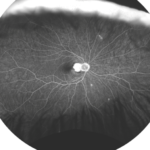 Clinical image illustrating CATT and IVAN (figure 1)