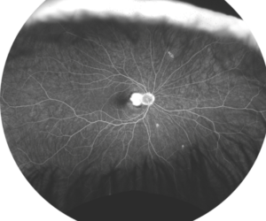 Clinical image illustrating CATT and IVAN (figure 1)