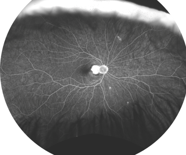 Clinical image illustrating CATT and IVAN (figure 1)