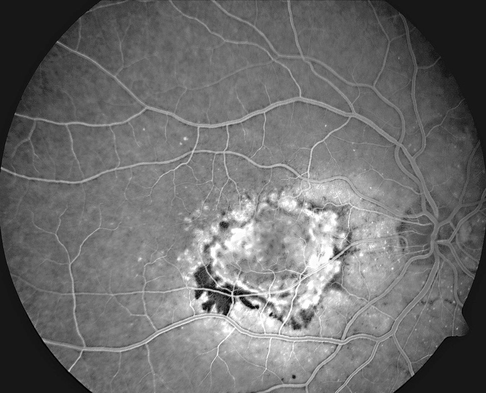 Clinical image illustrating CATT and IVAN (figure 2)