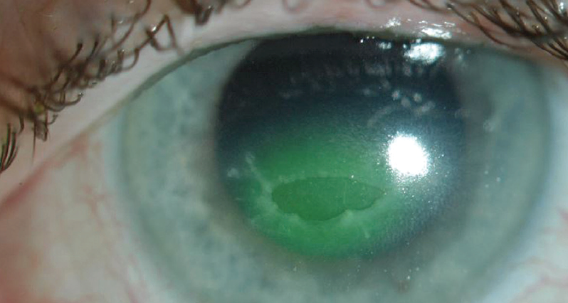 Clinical eye photograph illustrating Cenegermin Nerve Growth Factor Drops