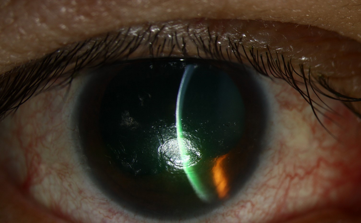 Clinical eye photograph illustrating Cenegermin Nerve Growth Factor Drops