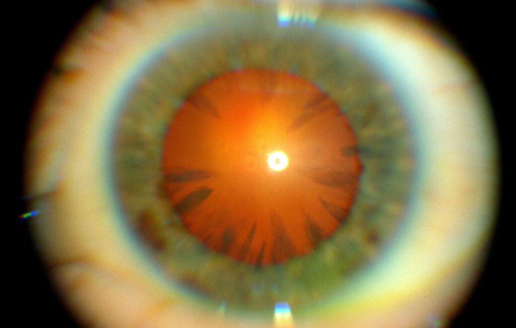 Clinical eye photograph illustrating Chalcosis Copper Intraocular Foreign Body
