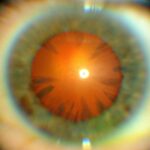Clinical eye photograph illustrating Chalcosis Copper Intraocular Foreign Body