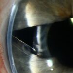 Clinical eye photograph illustrating Chandler Syndrome
