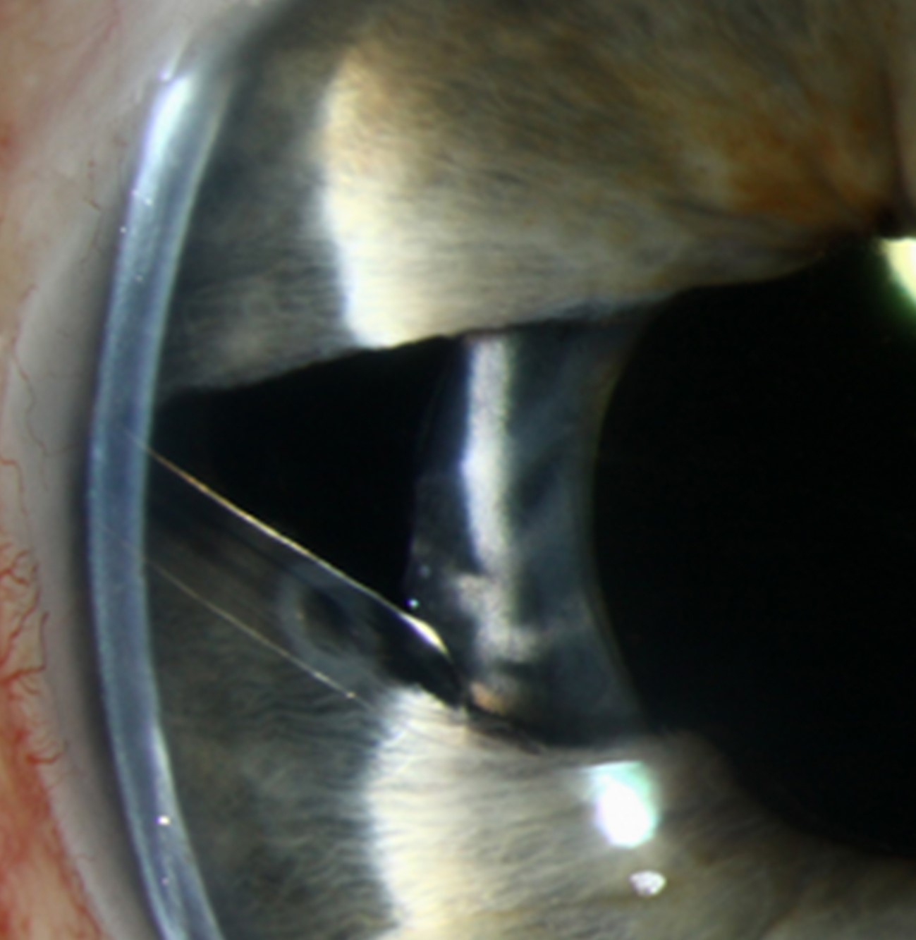 Clinical eye photograph illustrating Chandler Syndrome