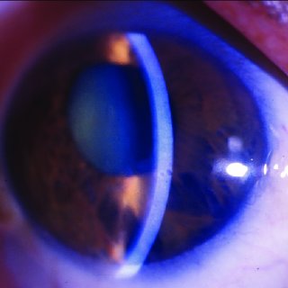 Clinical eye photograph illustrating Chandler Syndrome