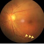 Clinical eye photograph illustrating Chikungunya Ocular Manifestations