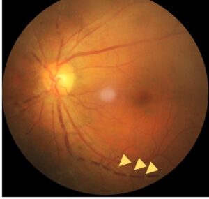 Clinical eye photograph illustrating Chikungunya Ocular Manifestations