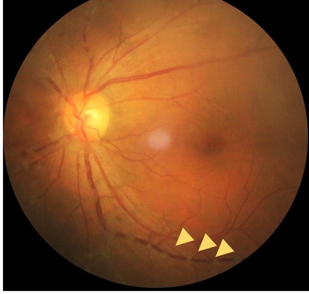 Clinical eye photograph illustrating Chikungunya Ocular Manifestations