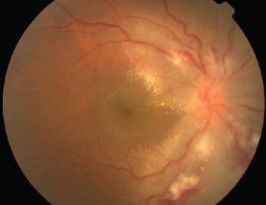 Clinical eye photograph illustrating Chikungunya Ocular Manifestations