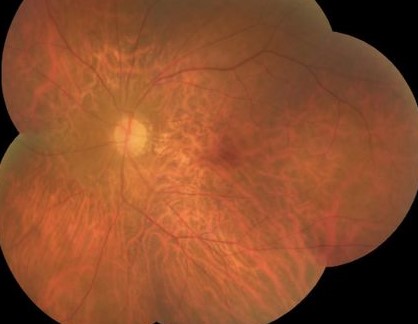 Clinical image illustrating Choriocapillaris