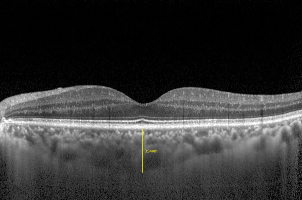 Clinical image illustrating Choroidal Thickness on EDI-OCT