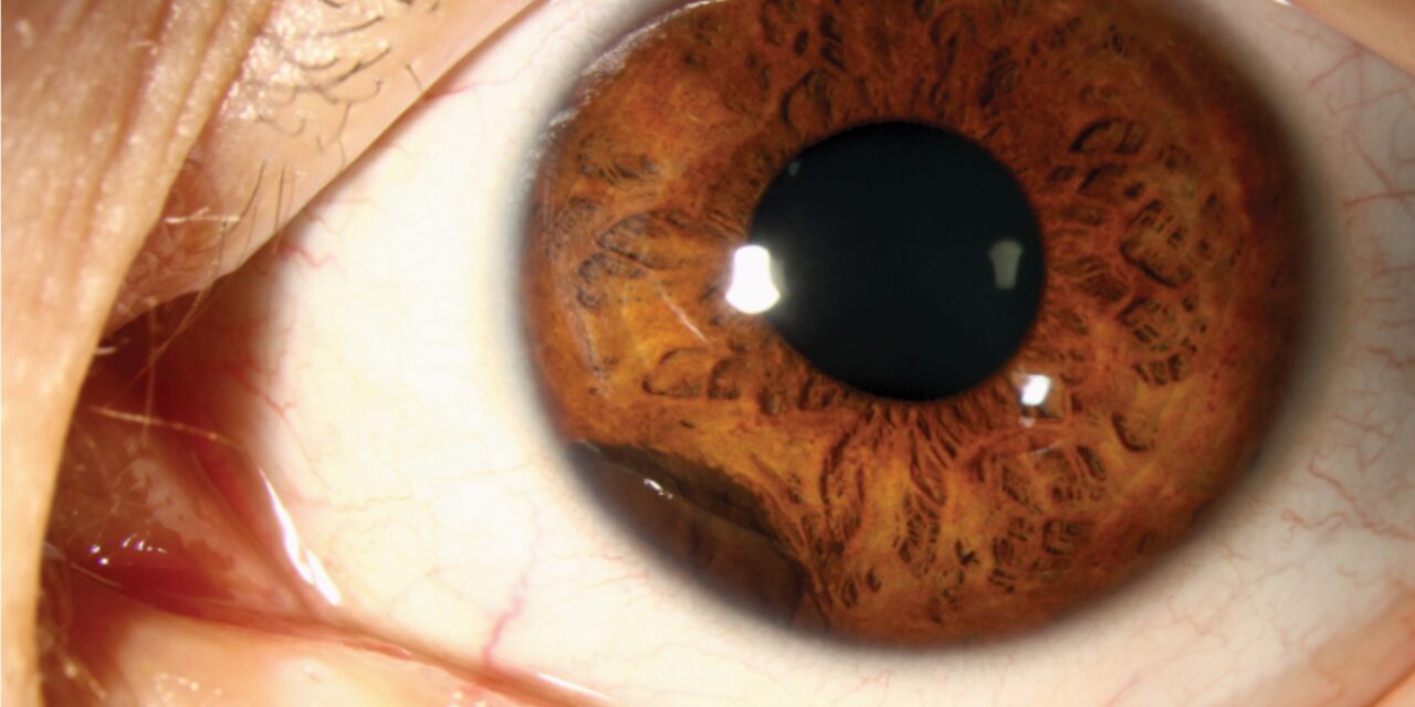 Ciliary Body Cysts: A Benign, Often Invisible Passenger Behind the Iris