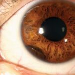 Clinical eye photograph illustrating Ciliary Body Cyst