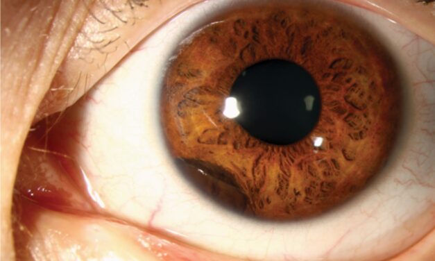 Ciliary Body Cysts: A Benign, Often Invisible Passenger Behind the Iris