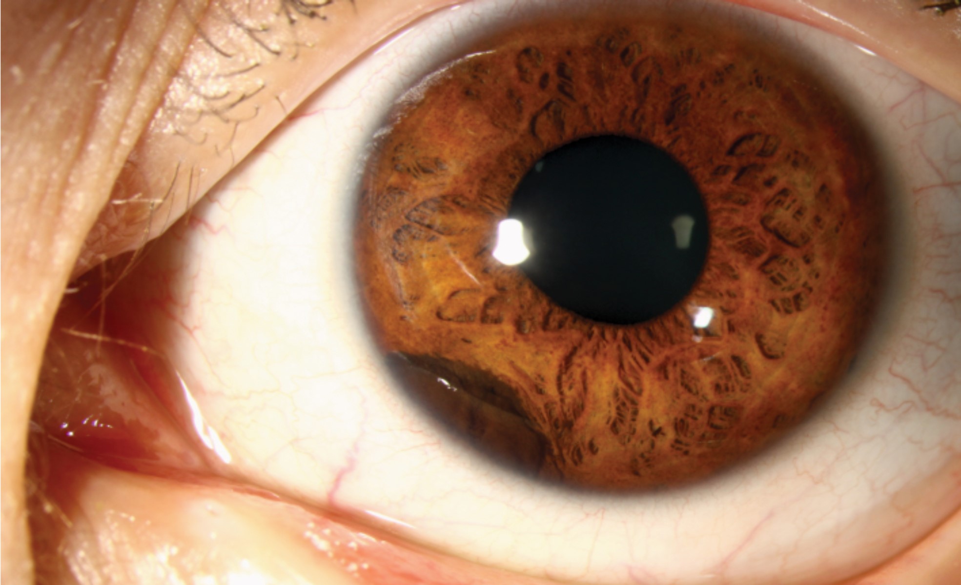 Clinical eye photograph illustrating Ciliary Body Cyst