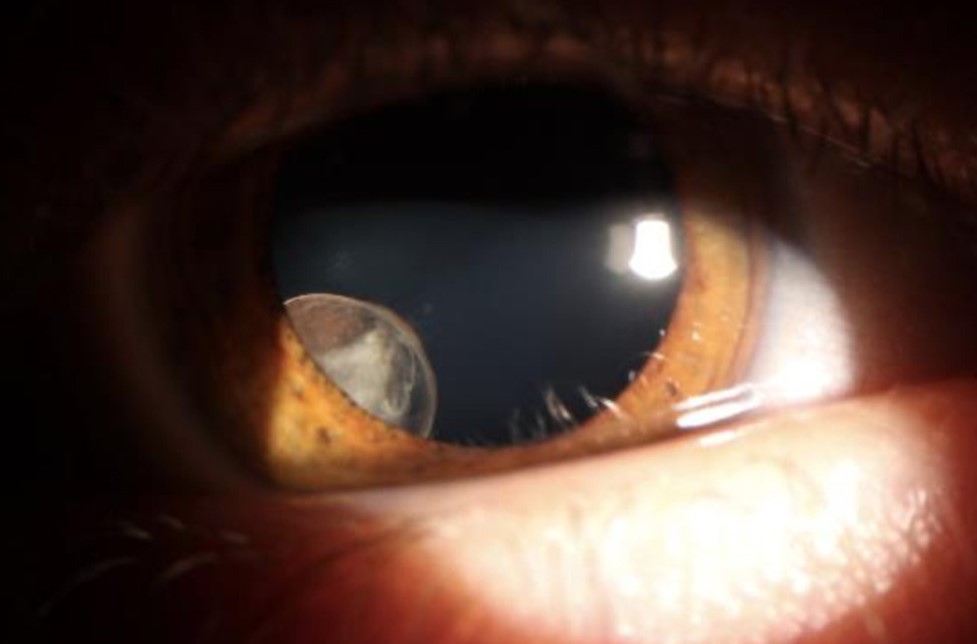 Clinical eye photograph illustrating Ciliary Body Cyst