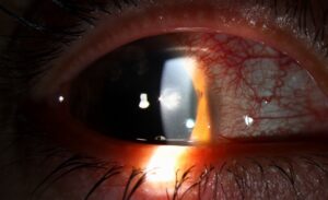 Clinical image illustrating Ciliary Flush (Circumcorneal Injection) (figure 1)