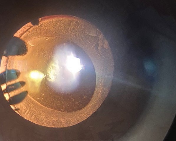 Clinical image illustrating Ciliary Flush (Circumcorneal Injection) (figure 2)
