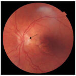 Clinical eye photograph illustrating Cilioretinal Artery Clinical Significance