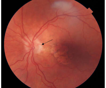 Cilioretinal Arteries: A Normal Variant That Can Quietly Save Central Vision