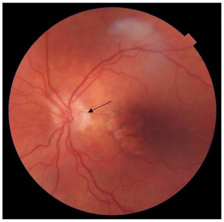 Cilioretinal Arteries: A Normal Variant That Can Quietly Save Central Vision