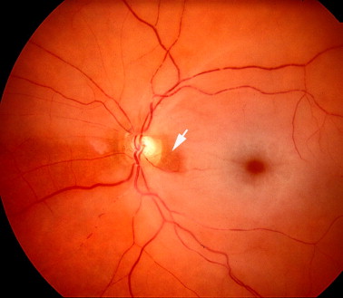 Clinical eye photograph illustrating Cilioretinal Artery Clinical Significance