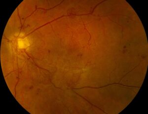 Clinical eye photograph illustrating Clarity Aflibercept Versus Prp Proliferative Diabetic Retinopathy