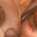 Clinical eye photograph illustrating Clear Corneal Incision Construction
