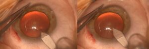 Clinical eye photograph illustrating Clear Corneal Incision Construction