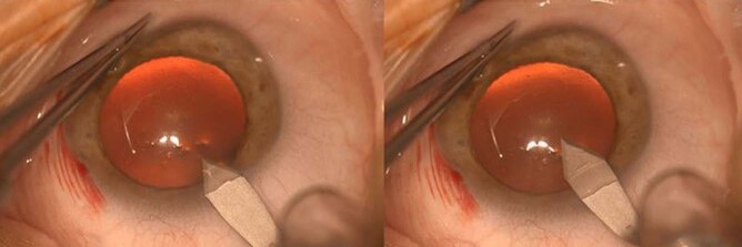 Clinical eye photograph illustrating Clear Corneal Incision Construction
