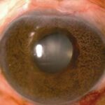 Clinical eye photograph illustrating Cogan Reese Syndrome