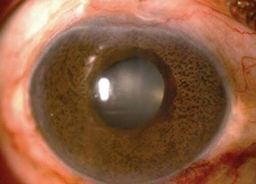 Cogan-Reese Syndrome: When the ICE Spectrum Grows Its Own Iris Nodules