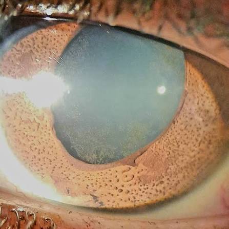 Clinical eye photograph illustrating Cogan Reese Syndrome