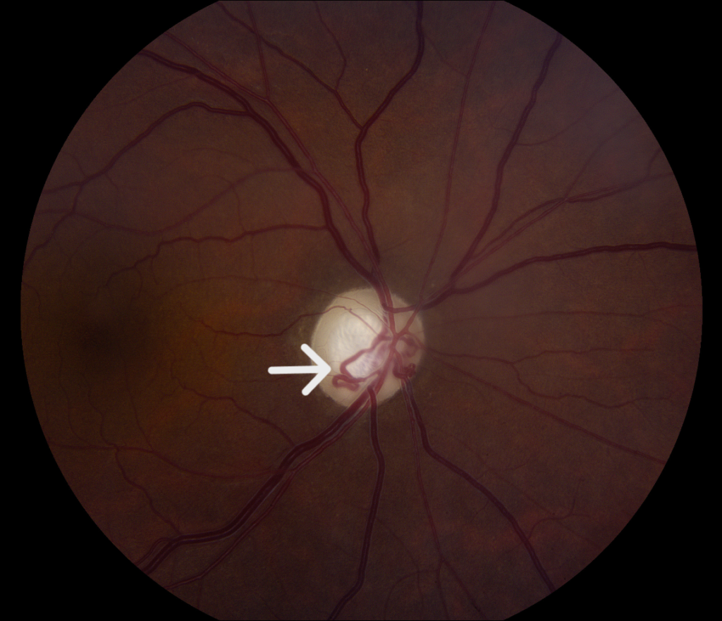 Clinical eye photograph illustrating Collateral Vessels Retinal Vein Occlusion