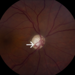 Clinical eye photograph illustrating Collateral Vessels Retinal Vein Occlusion