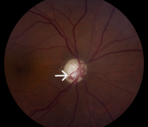 Clinical eye photograph illustrating Collateral Vessels Retinal Vein Occlusion