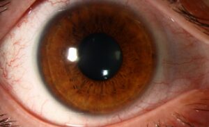 Clinical eye photograph illustrating Comet Blink Myopia Lens Trials