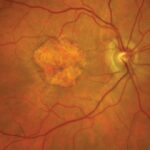 Clinical eye photograph illustrating Complement Inhibitors Geographic Atrophy
