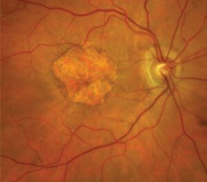 Clinical eye photograph illustrating Complement Inhibitors Geographic Atrophy
