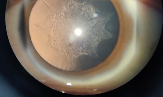 Complicated Cataract: When Another Eye Disease Is the Reason the Lens Clouded