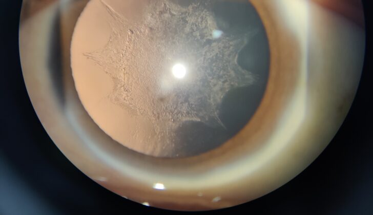 Complicated Cataract: When Another Eye Disease Is the Reason the Lens Clouded