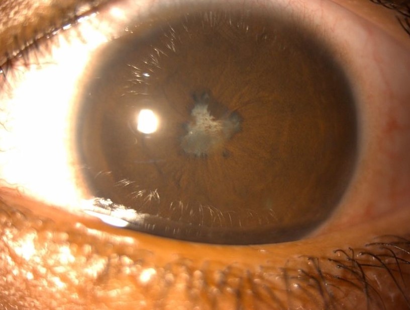 Clinical eye photograph illustrating Complicated Cataract Secondary