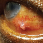 Clinical eye photograph illustrating Conjunctival Granuloma